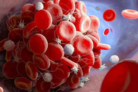 covid long molecules inflammatoires dans microcaillots sanguins