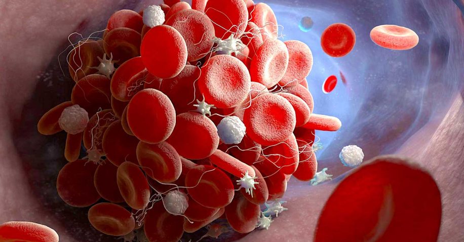 covid long molecules inflammatoires dans microcaillots sanguins