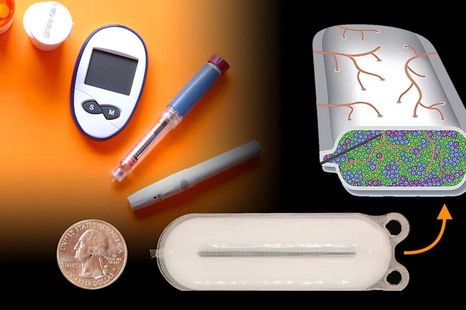 diabete type 1 nouveau traitement secreteur insuline