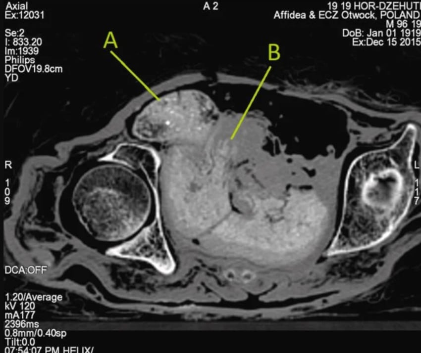 ct-scan foetus momie