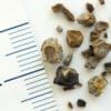 calcul renal lithotripsie onde sonore sans chirurgie