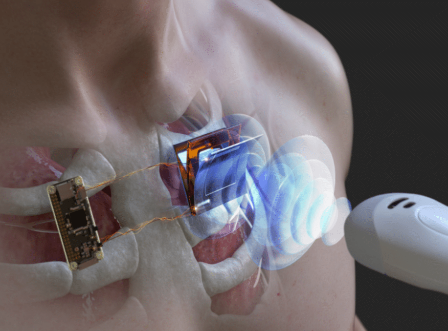 ultrasons recharge implants cardiaques sous marins