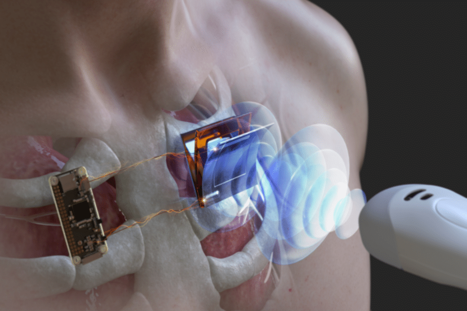 ultrasons recharge implants cardiaques sous marins