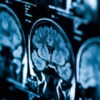 declin cognitif covid long severe vieillissement 20 ans couv