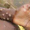 variole singe augmentation nombre cas rapide epidemie