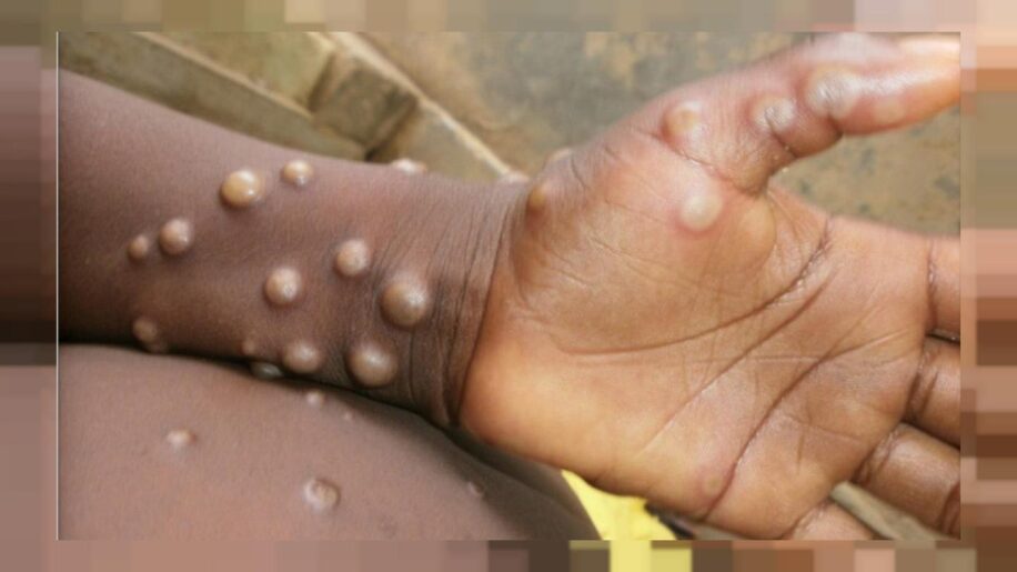 variole singe augmentation nombre cas rapide epidemie