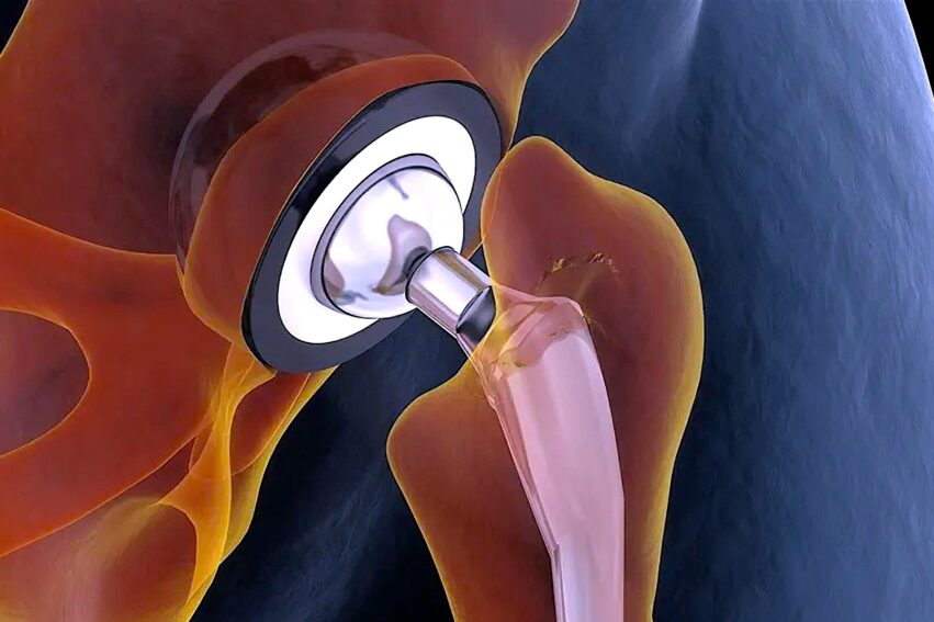 alliage metallique flexible resistant implants durables