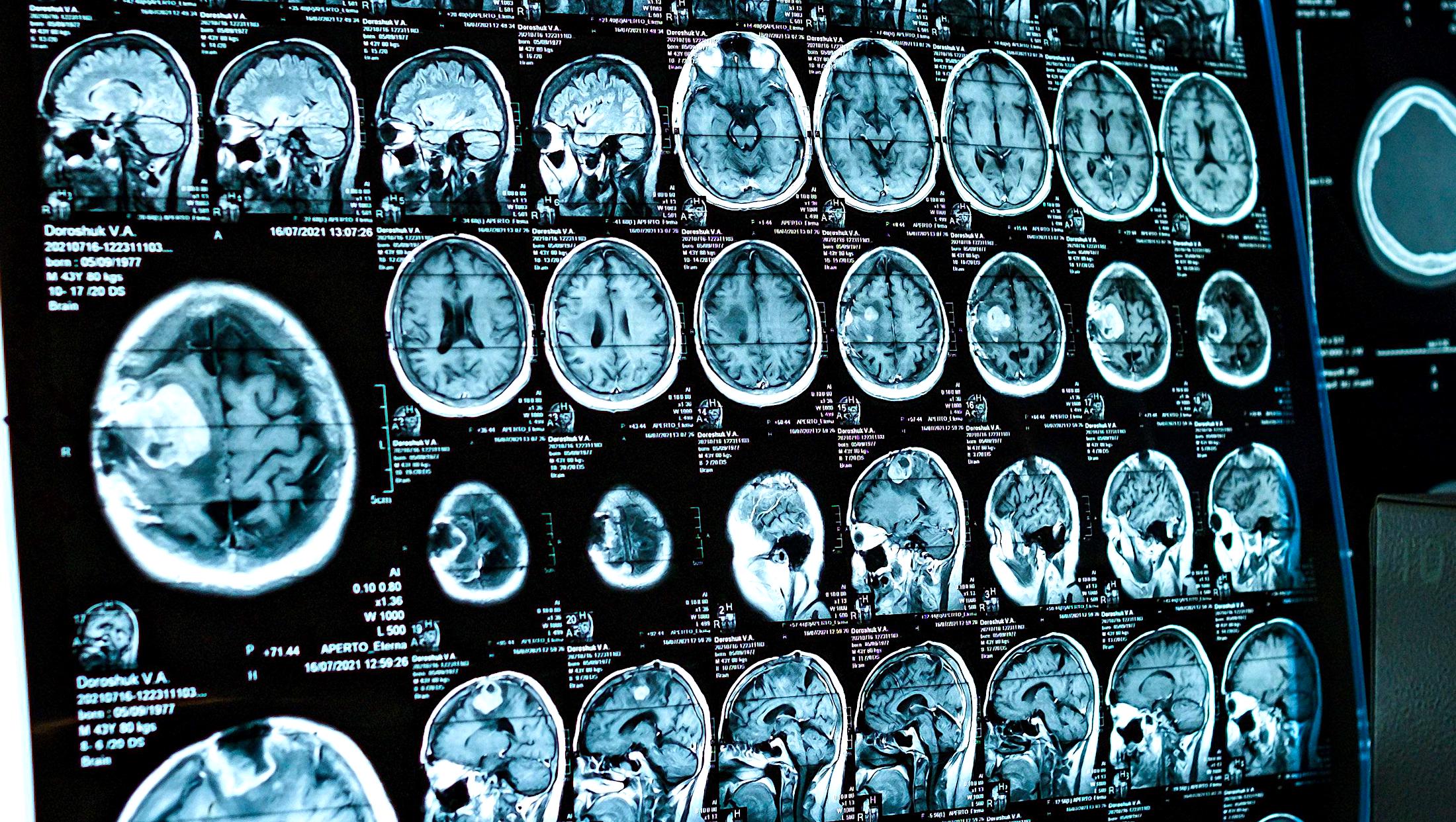 Le scansioni MRI mostrano un invecchiamento precoce del cervello negli adolescenti