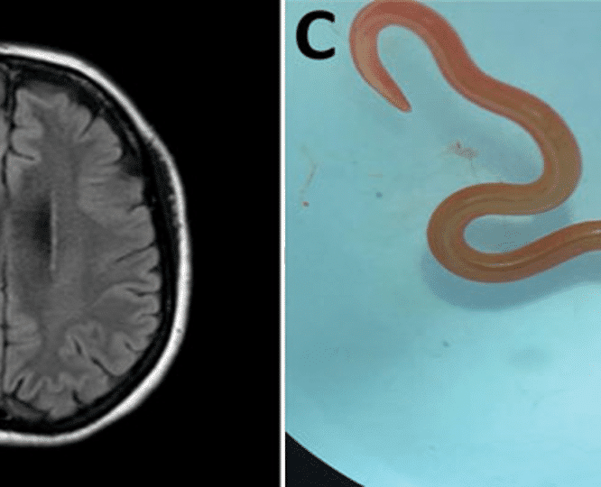 parasite ver python cerveau humain couv