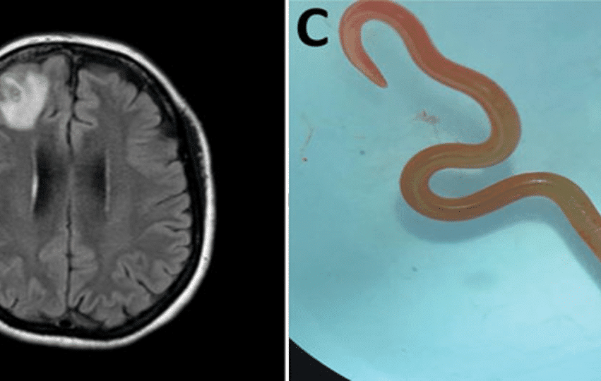 parasite ver python cerveau humain couv