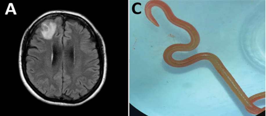 parasite ver python cerveau humain couv