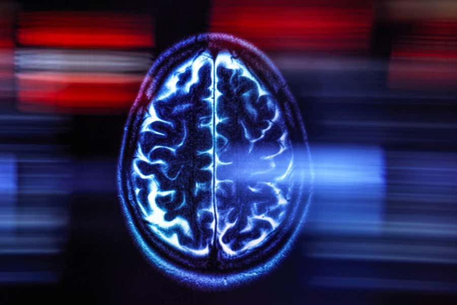 Alzheimer cerveau image