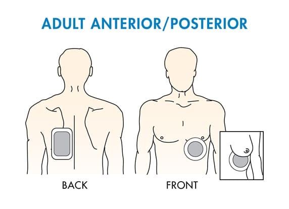 PadPlacement Adult AnteriorPosterior