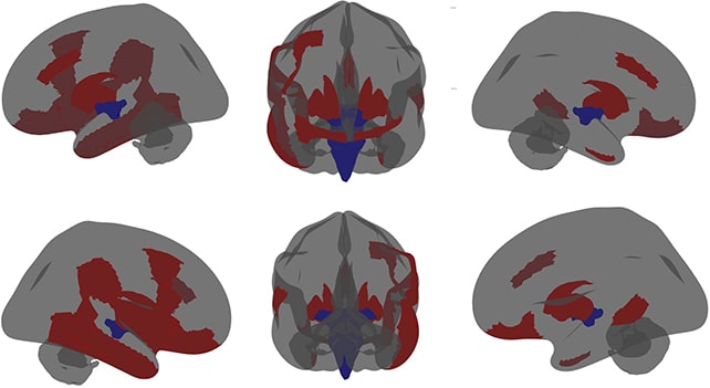 cerveau autistes