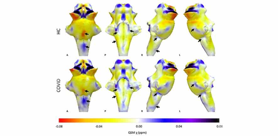 covid tronc cerebral