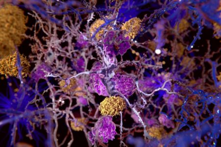 Alzheimer un nouveau traitement contre la maladie rétrécit le cerveau mais cela pourrait être une bonne chose selon une nouvelle étude