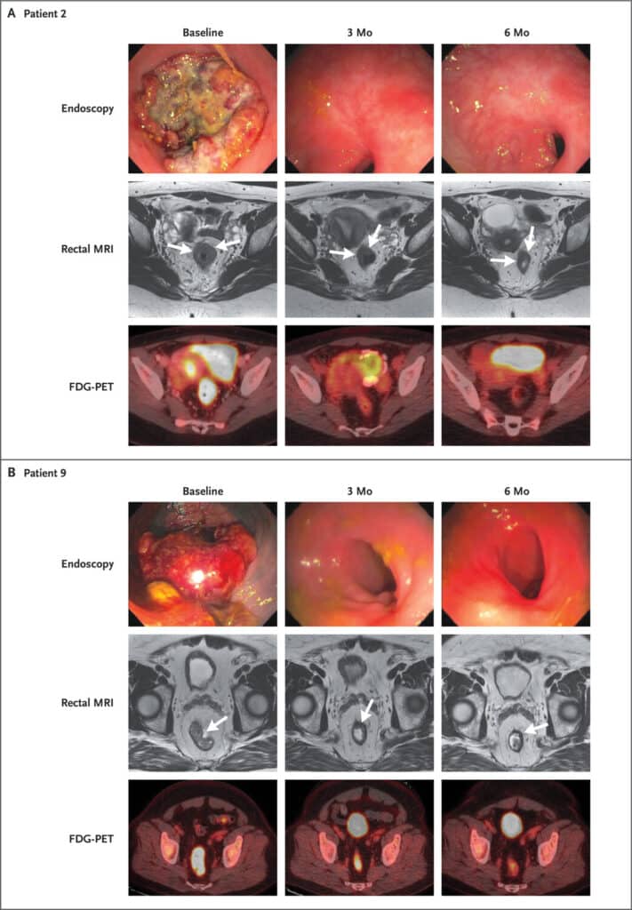 cancer rectum