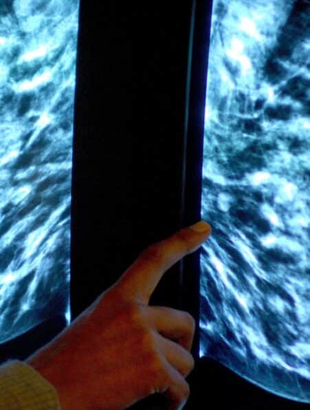 Cancer du sein l IA détecte davantage de cas selon une étude d envergure en conditions réelles