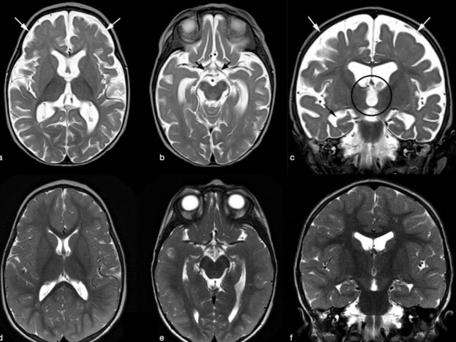 vitamine b12 apport recommande insuffisant pour cerveau etude revele lien avec declin neurologique couv