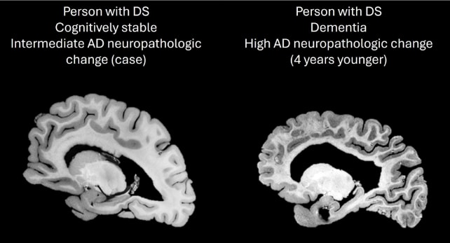 Comparaison des cerveaux de deux personnes atteintes du syndrome de Down