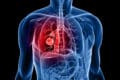 alimentation cancer poumon lien