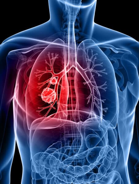 alimentation cancer poumon lien