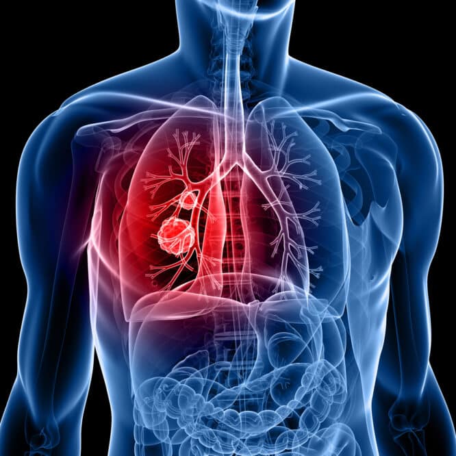 alimentation cancer poumon lien