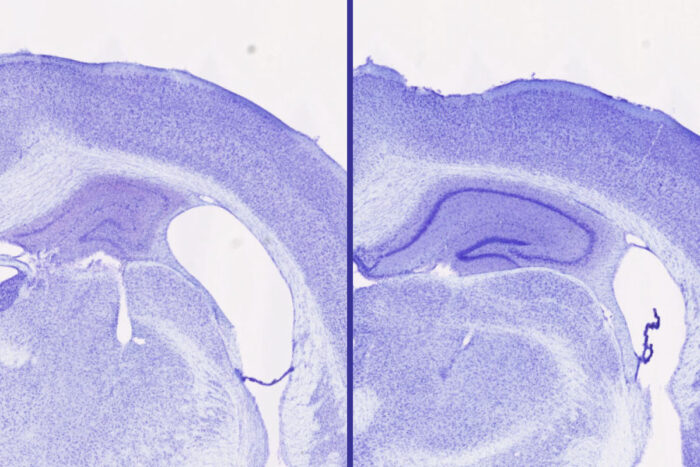 Lemborexant alzheimer