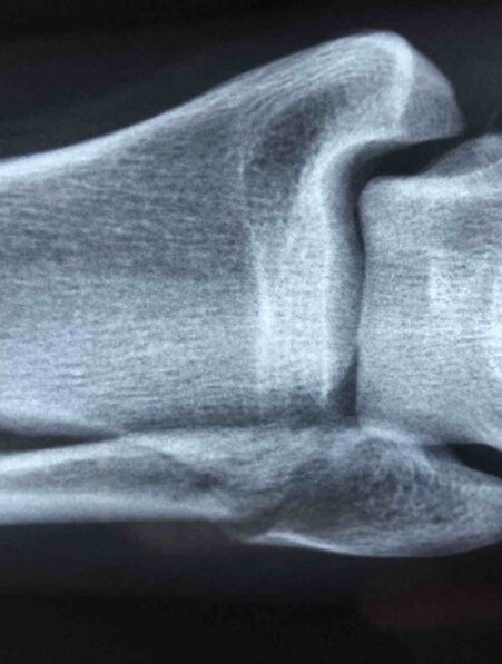 microplastique os sante