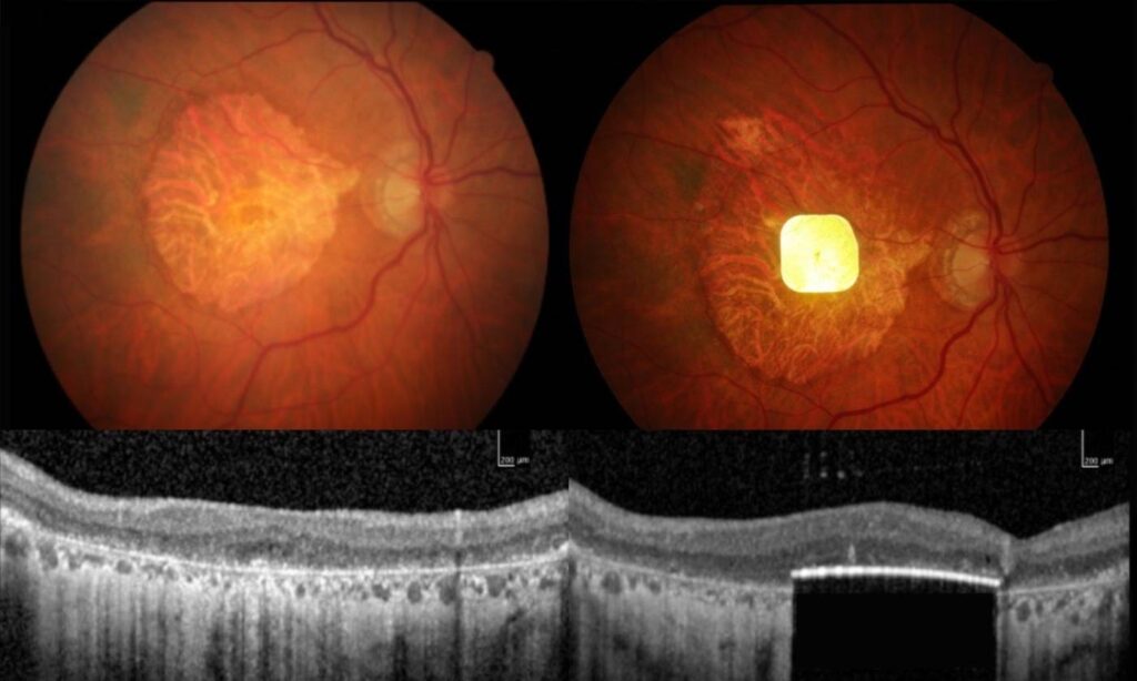 implant oeil