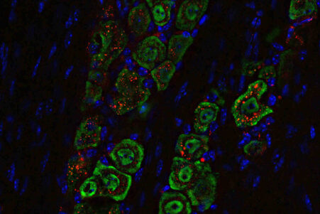nanoparticules-gouttes-nasales-glioblastome-couv