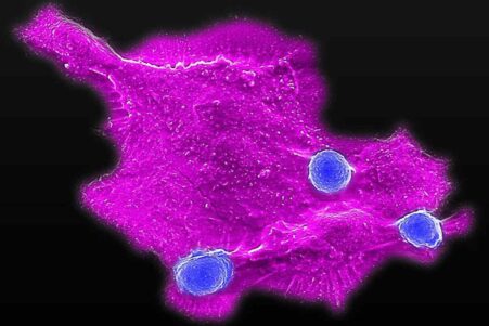 CAR-T-cancer-sein-couv