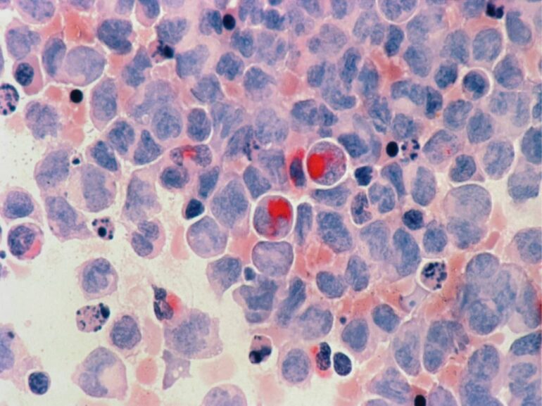 La recherche sur la ferroptose ouvre de nouvelles perspectives dans le traitement du cancer